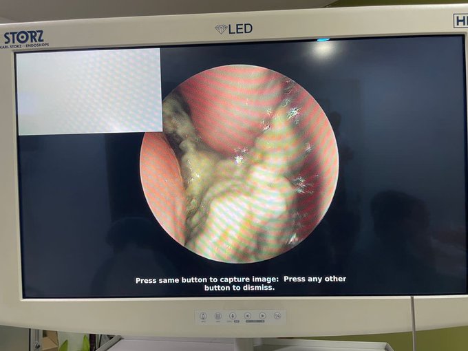 时常嗅到异味找耳鼻喉 男子:原来鼻生石!