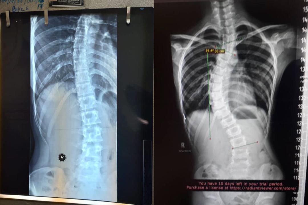 视频|父亲抱少女逛商场引议论  姐姐：我们都患脊柱侧弯