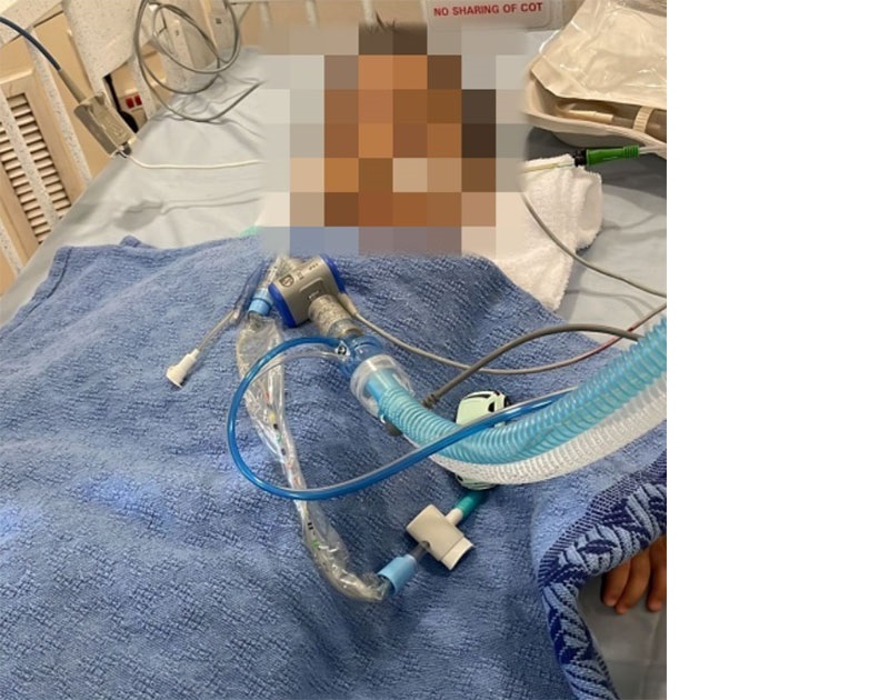 1岁半儿冠病并发症死亡“我只能看著他停止呼吸”