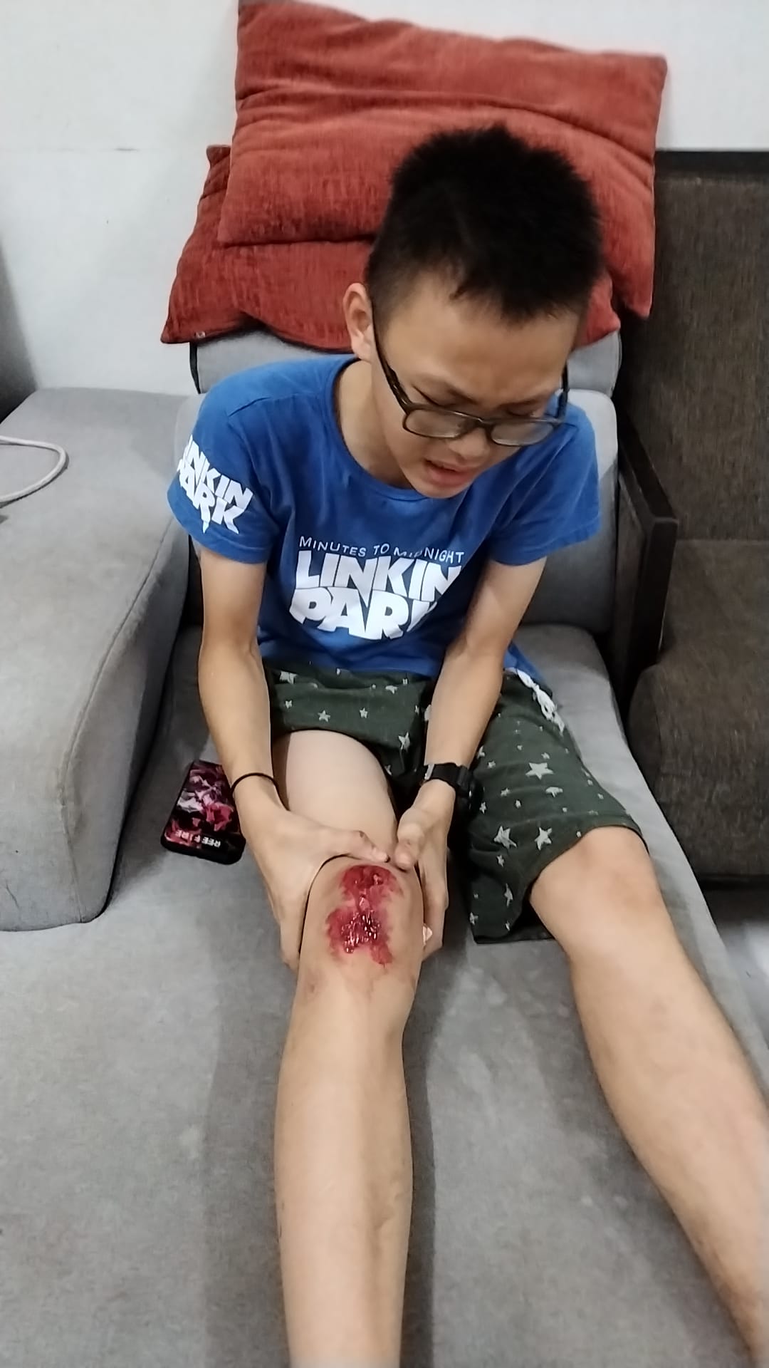 东：男童骑脚车撞及路边坑洞膝盖皮开肉绽
