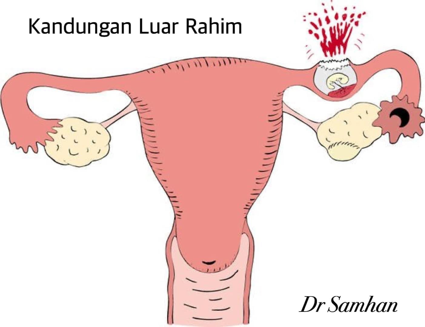 女子宫外孕出血 母亲叫回家推拿摆正胚胎 医生:会死人的!