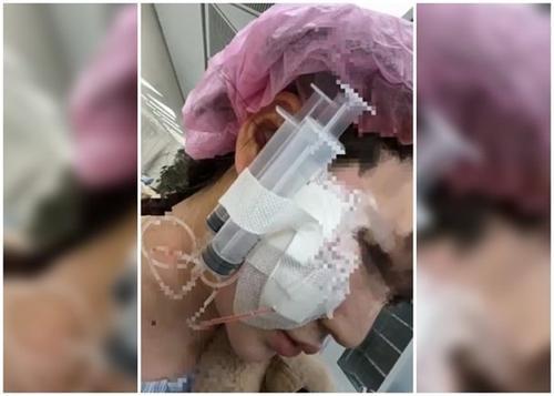拚图）女子打针降颧骨　细菌感染致脸肿毁容