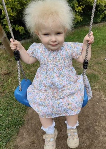 拼盘/乱发症候群 全球只有100人有