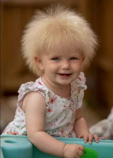 拼盘/乱发症候群 全球只有100人有