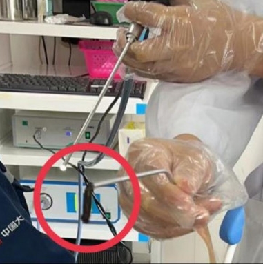 拼盘/男子频频流鼻血 求医始知鼻腔藏蚂蟥