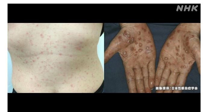 日本梅毒病例激增 年底恐破万例