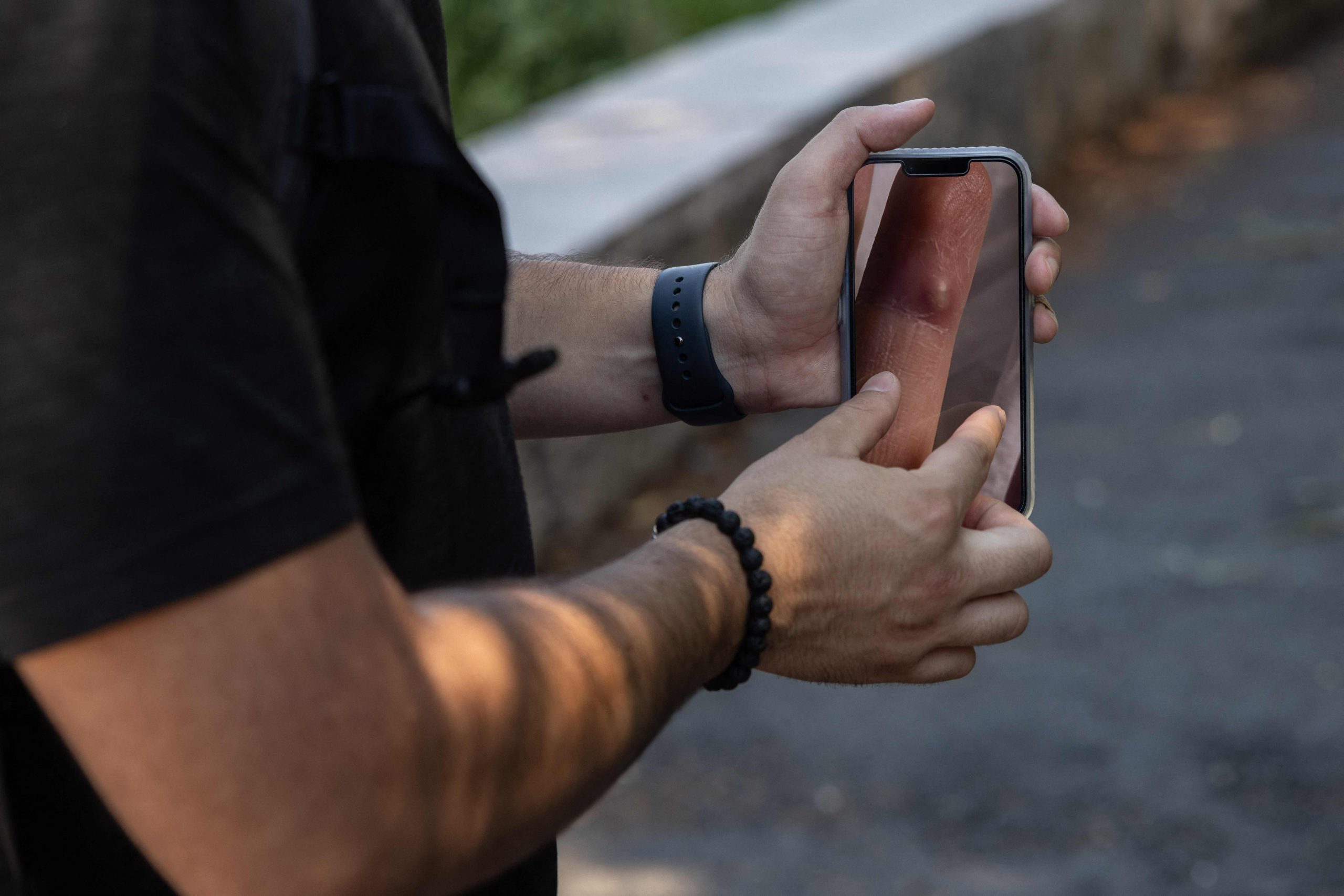 曾与数名男子发生关系 猴痘男患者:如厕洗澡痛到尖叫