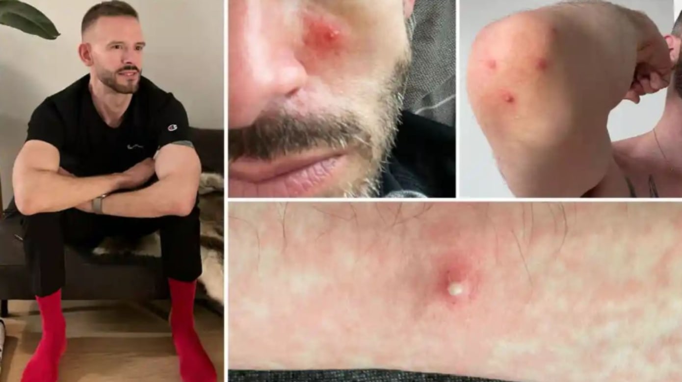 曾与数名男子发生关系 猴痘男患者:如厕洗澡痛到尖叫