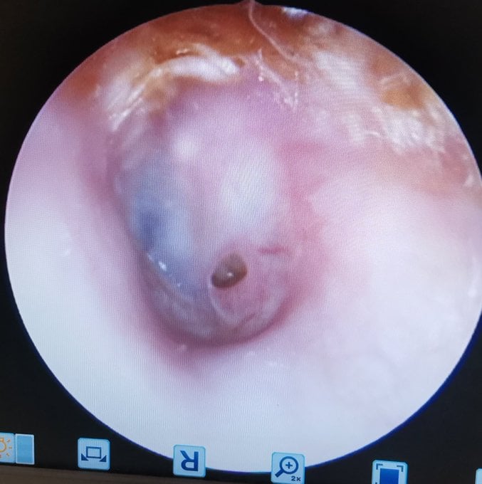 耳垢有5大功能无需挖掉 耳鼻喉专科:小心挖破耳膜