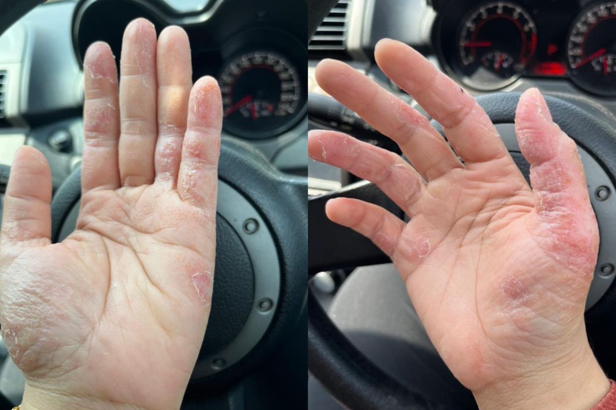 视频|患湿疹不能做家务煮三餐 女子:抓饭吃也要戴手套!