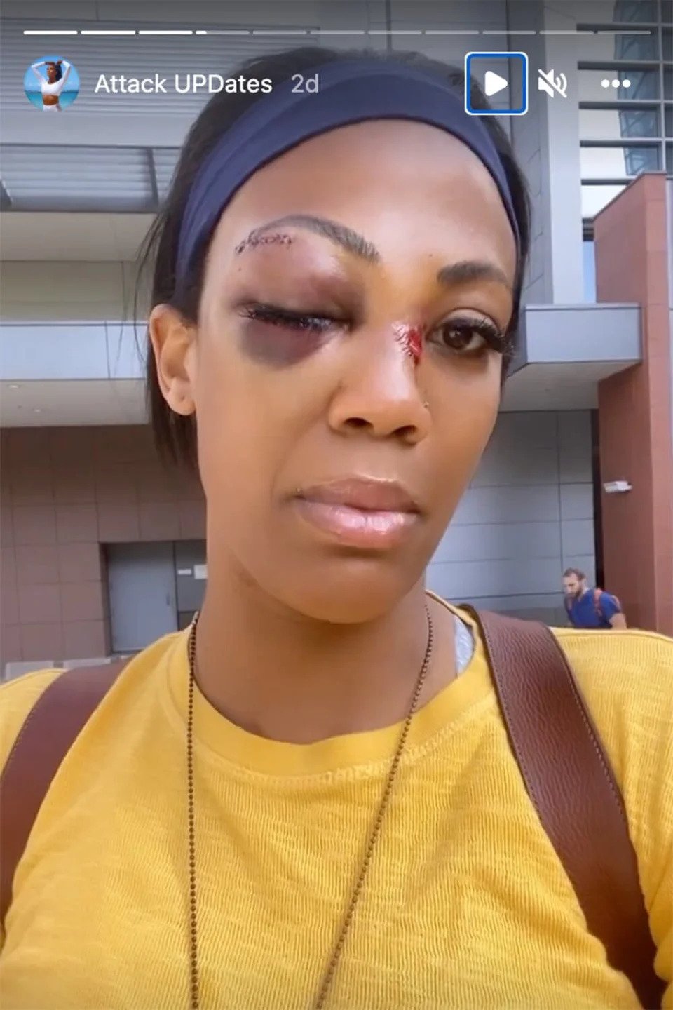 遭流浪汉持械袭击  美国女排名将面部多处骨折