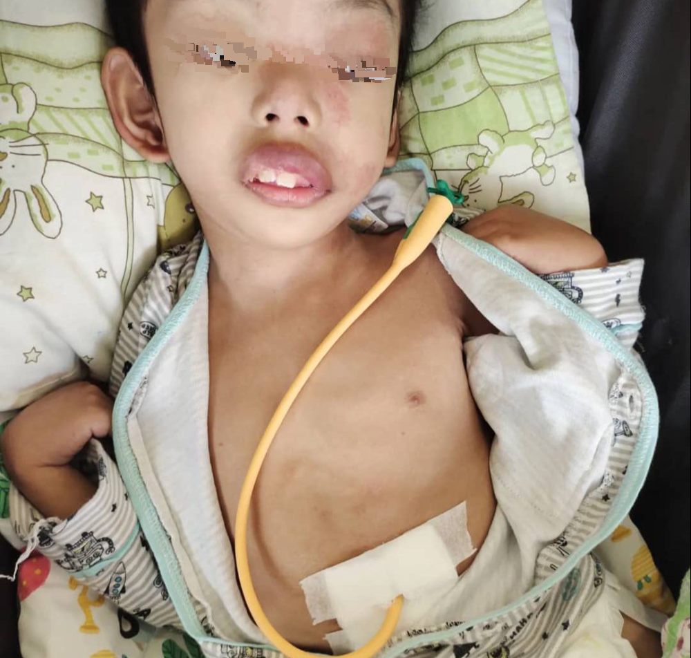 ​8月大患脑积水 头部腹部都开洞 母心酸“8岁仍遭折腾”