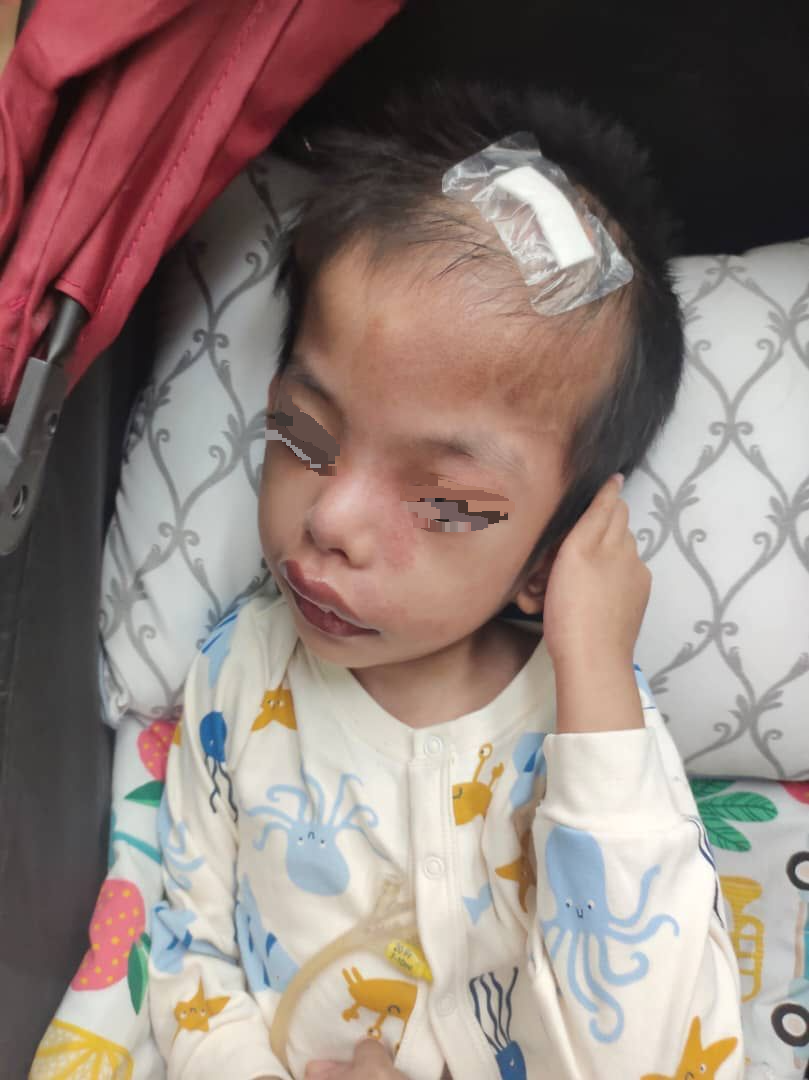 ​8月大患脑积水 头部腹部都开洞 母心酸“8岁仍遭折腾”