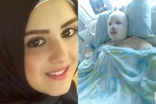 嫩妻怀孕5月拒绝堕胎！竟被狠夫“放火焚烧”　全身100％灼伤亡