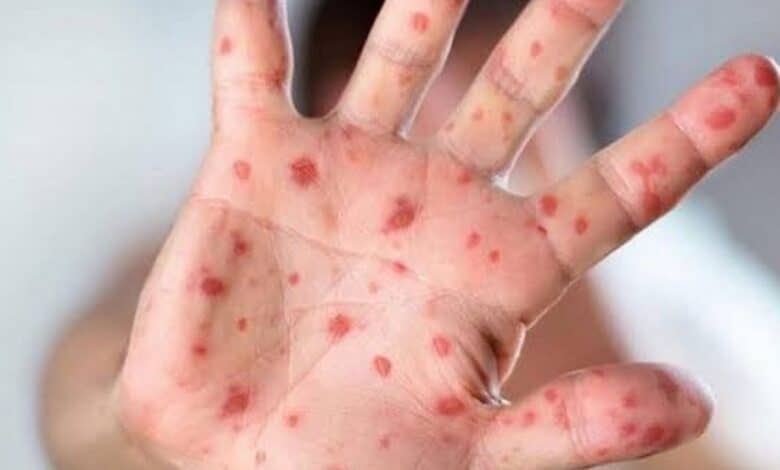 德国报告首例儿童猴痘病例