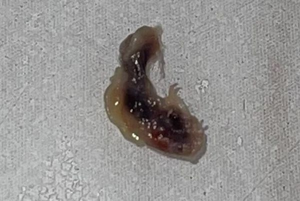 拼盘 /她睡醒眼皮出现小点 伤口红肿变大!3天后窜出异形寄生虫