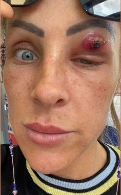 拼盘 /她睡醒眼皮出现小点 伤口红肿变大!3天后窜出异形寄生虫