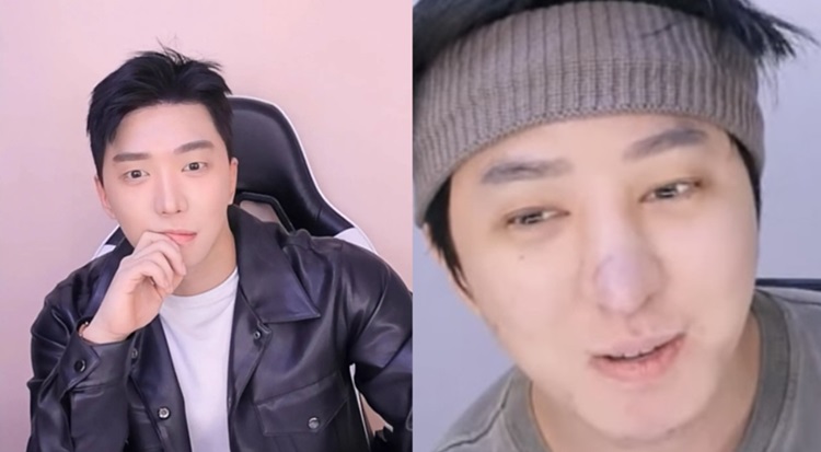 拼盘／型男网红整型失败　“鼻子融化”照吓坏万千粉丝