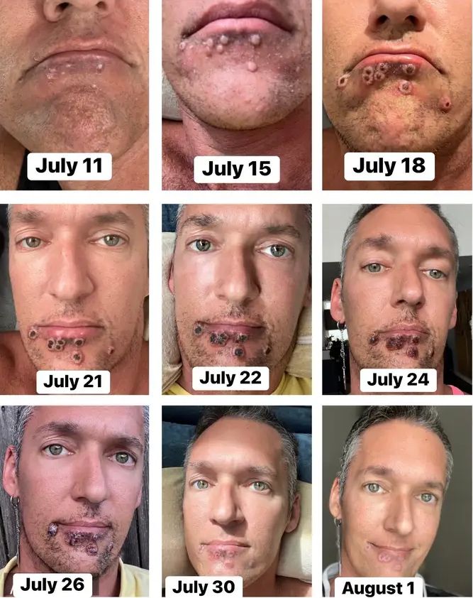 染猴痘“下巴长皮疹”病程照曝光 AV男优剧痛险昏倒:就像刀在刺