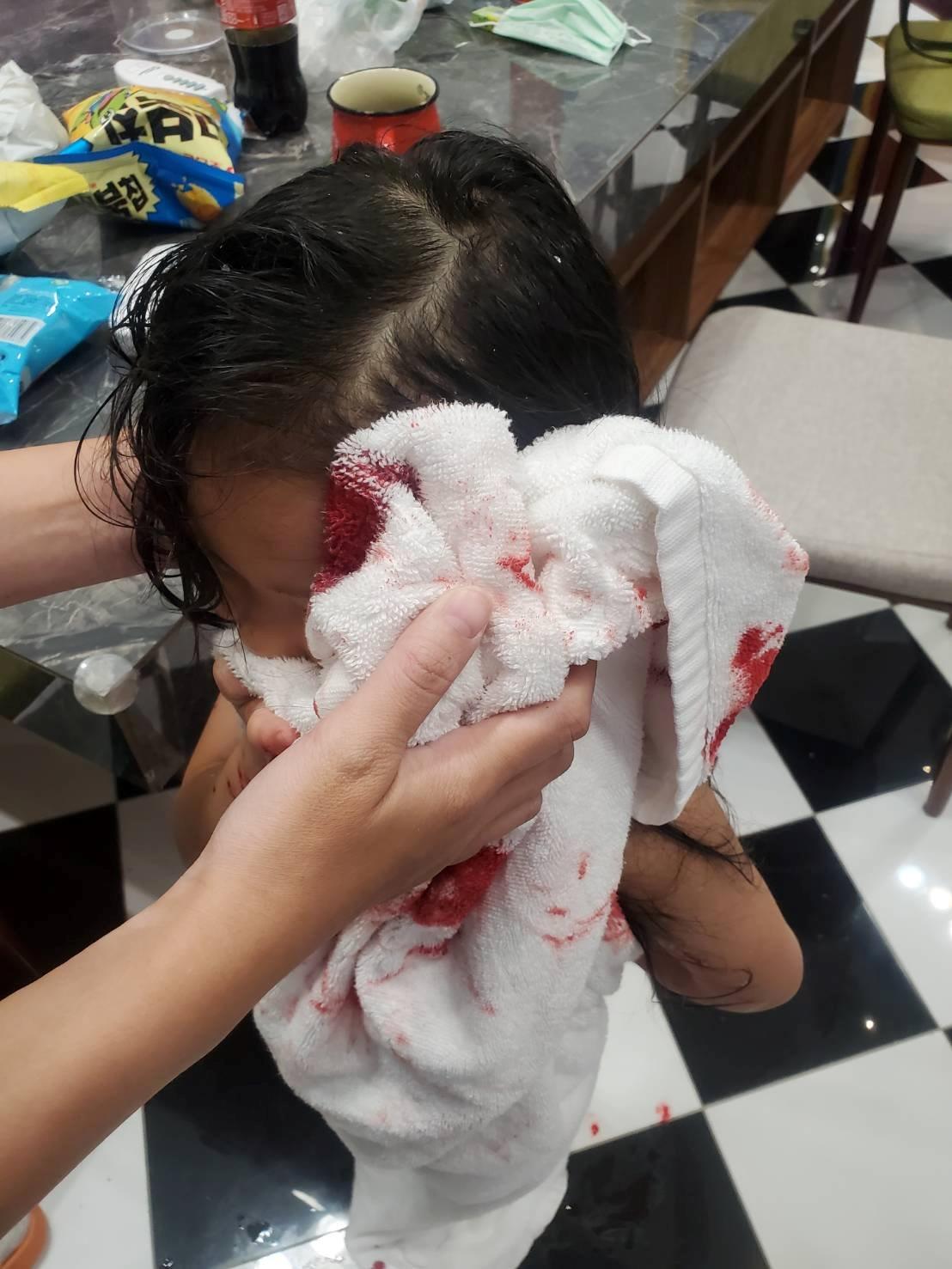 民宿玻璃门爆裂3女童伤 连续出事老板娘推说不知道