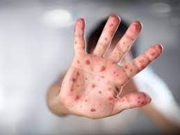 看世界／神秘“番茄流感”全身长诡异红疹　印度80童染病、传已夺58童命