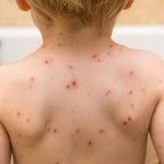 看世界／神秘“番茄流感”全身长诡异红疹　印度80童染病、传已夺58童命