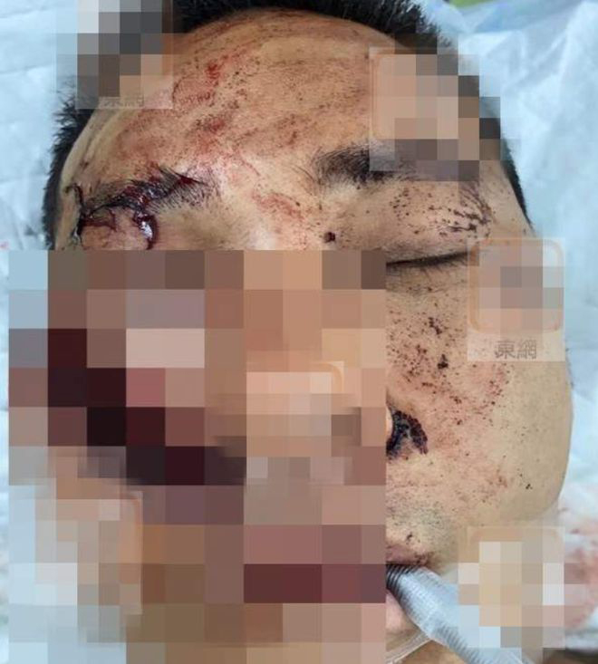 “翻版古天乐”遇袭被砍3刀  脸手缝100针凶徒竟称砍错人