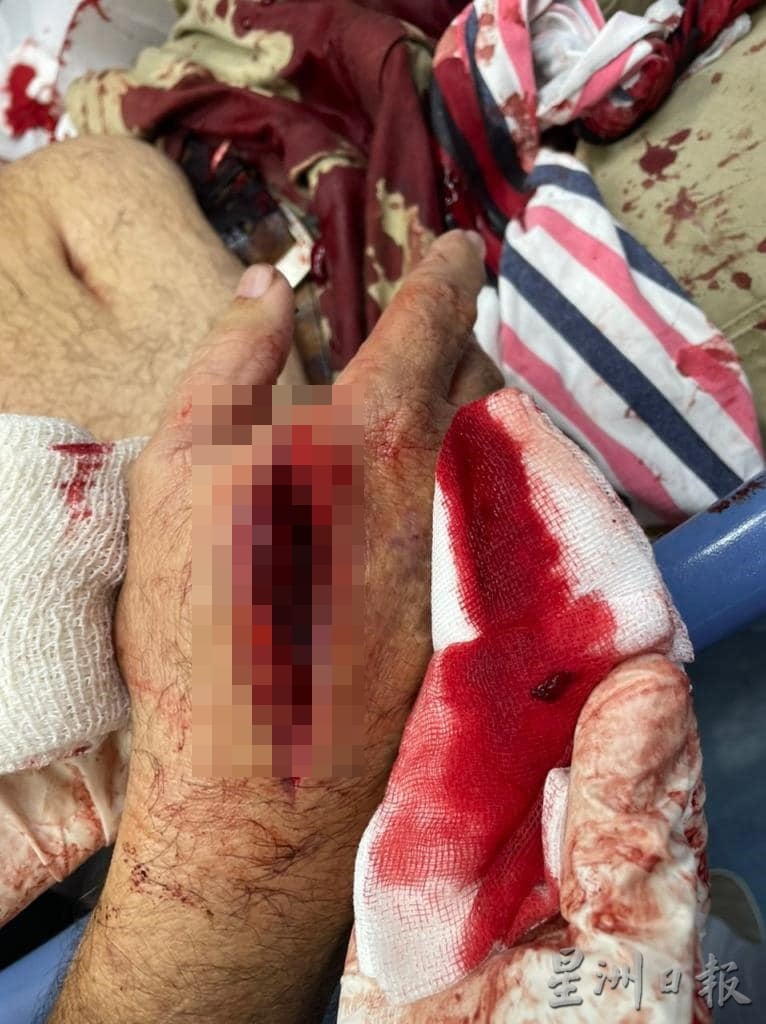 东:2名窃贼持利器入屋行窃并挥刀伤人,1名长者被挥中5刀,皮开肉绽。