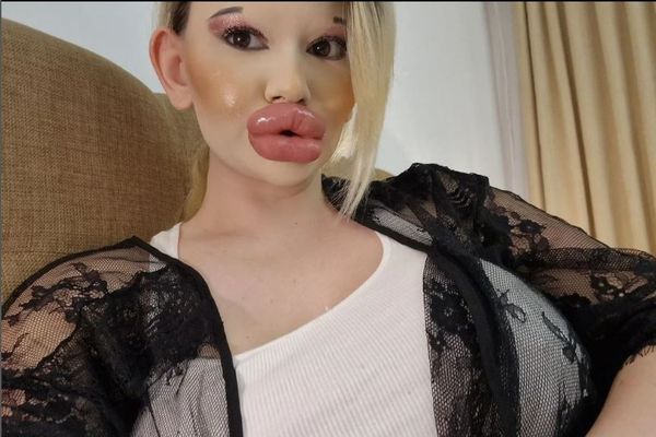 她狂打30次玻尿酸“丰唇变大香肠” 医警告:再整就堵住鼻孔