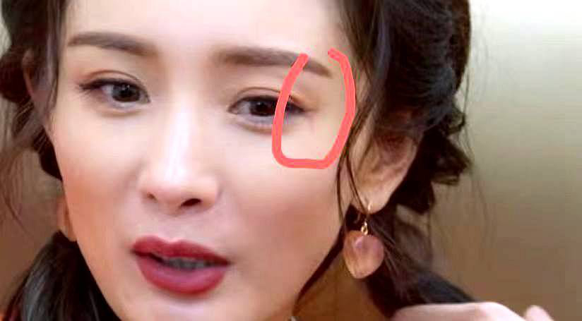 杨幂眼角受伤2个月 伤疤首度曝光