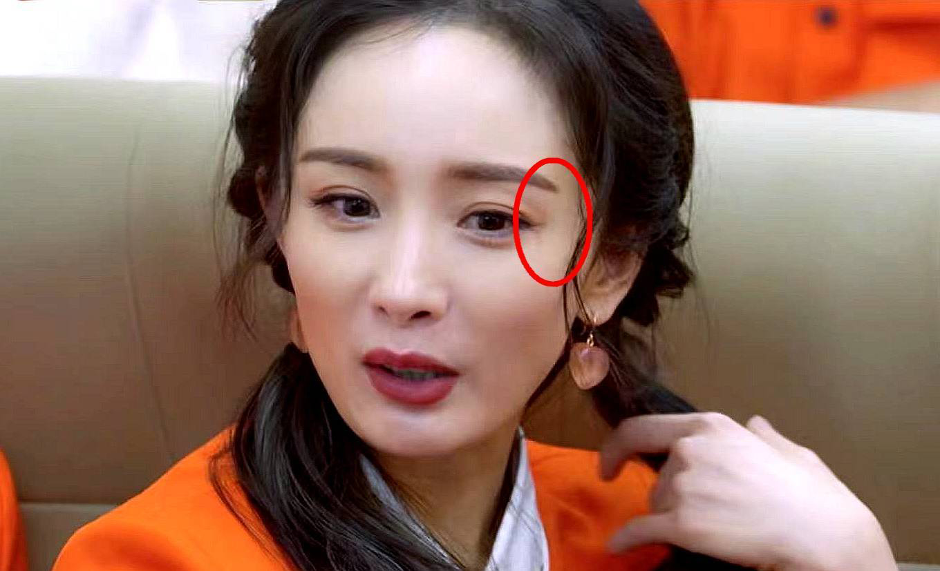 杨幂眼角受伤2个月 伤疤首度曝光
