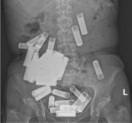 爱尔兰66岁老妇吞下55颗电池 胃下垂到耻骨附近