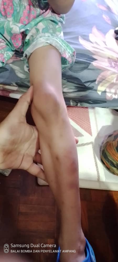 男童疑受虐满身伤·爬4楼窗檐获救