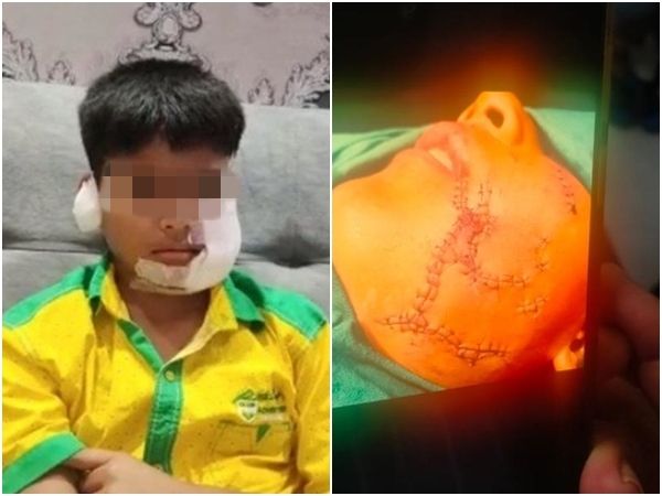 男童被狗狂咬缝150​​针 狗主没牌照只罚280元