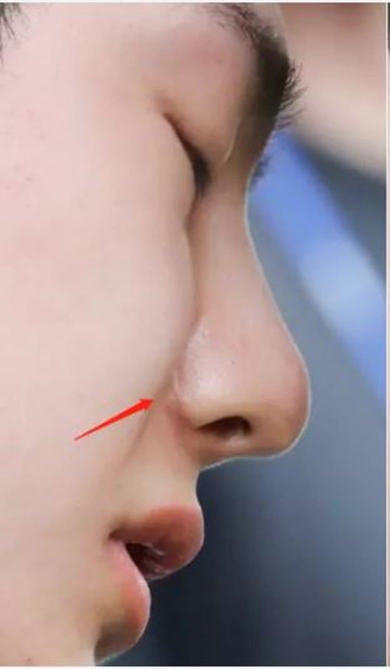 网疯传鼻翼疤痕照 王一博再陷整容风波