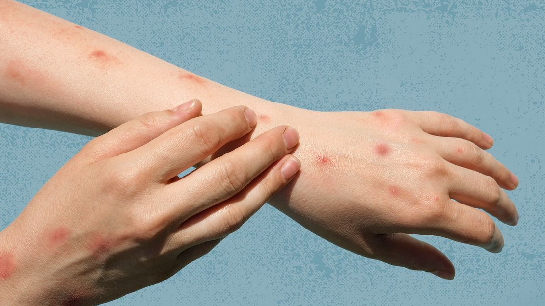 重庆猴痘确诊个案 与德国病毒高度同源