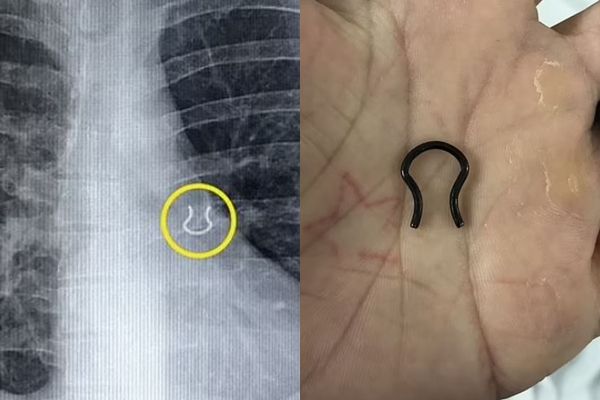 鼻环消失5年竟是掉进肺里！他狂咳到以为得肺炎　X光泄密