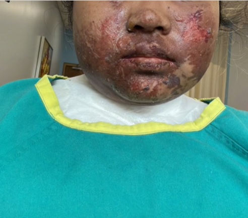 压力锅突炸开 女子遭滚汤严重灼伤