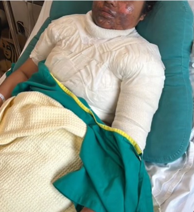 压力锅突炸开 女子遭滚汤严重灼伤