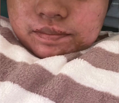 压力锅突炸开 女子遭滚汤严重灼伤