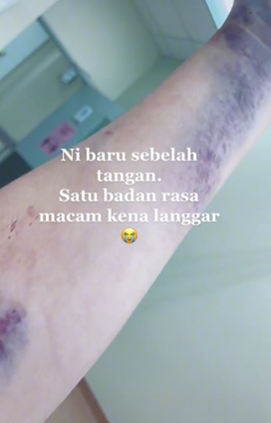 孕妇生产后全身紫红瘀青 医生:胎盘黏子宫壁造成!