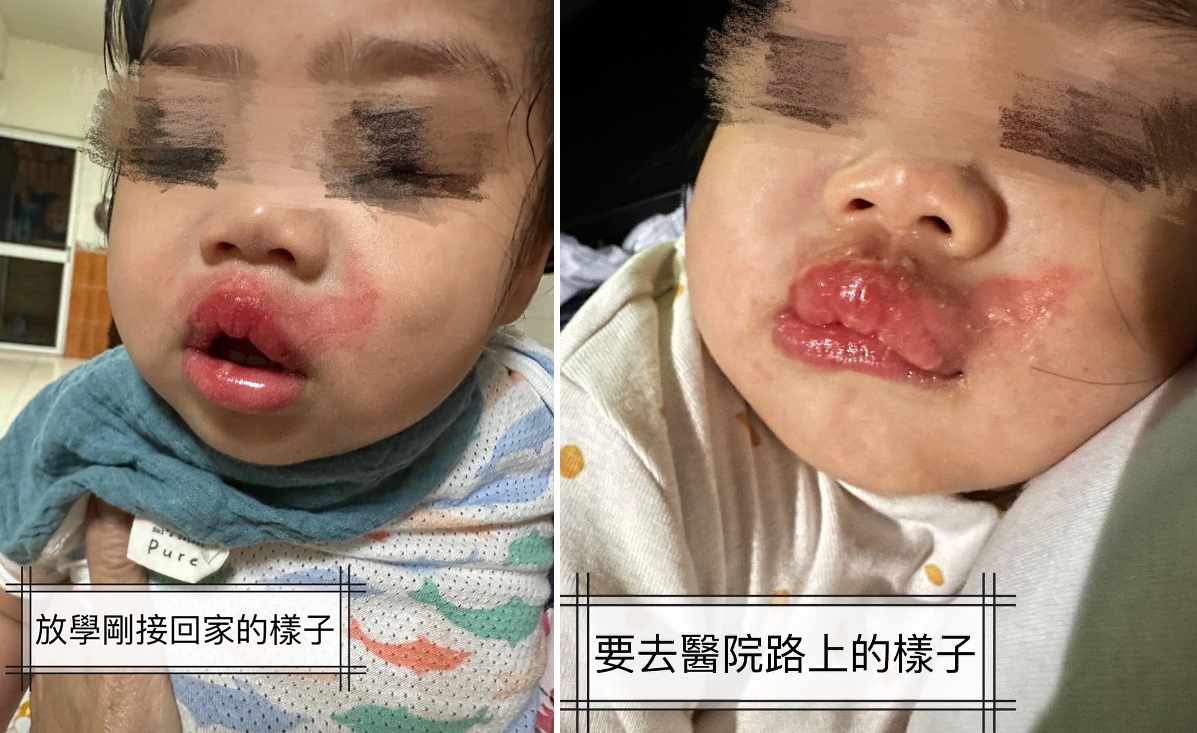 托婴中心70度奶水强灌 1岁女童肿成香肠嘴