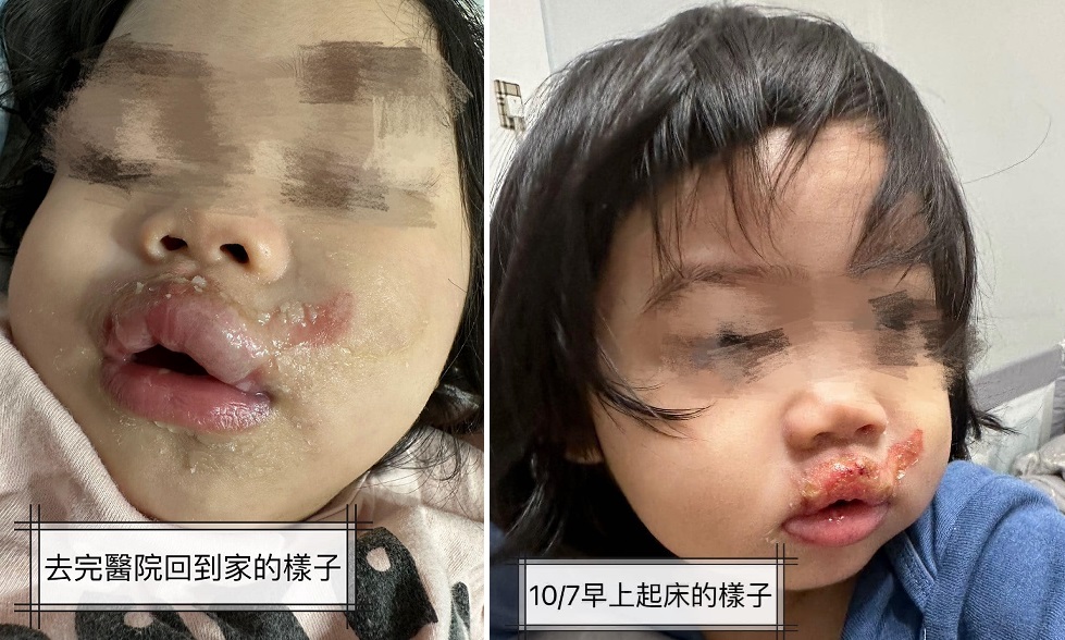 托婴中心70度奶水强灌 1岁女童肿成香肠嘴