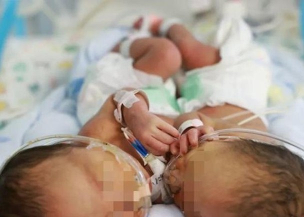 拼盘／连体婴出生后40天　接受手术平安分离