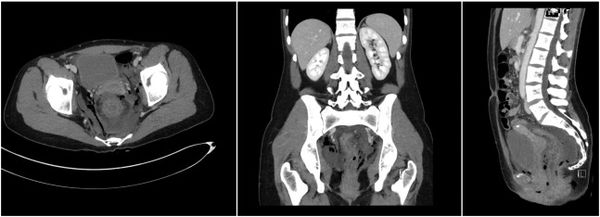 玩水上摩托下体受重创 女子须装人工肛门