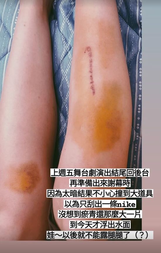 郭静撞伤脚刮出一条Nike　叹以后不能露腿了
