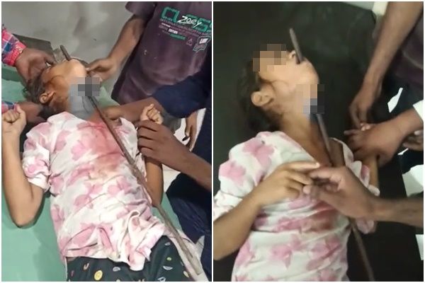 铁条下巴穿嘴出 女童跌倒险送命