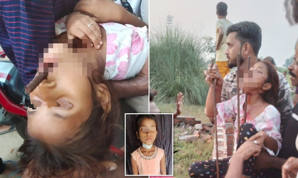 铁条下巴穿嘴出 女童跌倒险送命