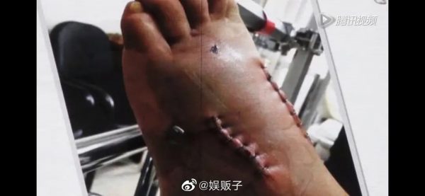 黄晓明自爆左脚植钢钉  全是劣质钢丝惹祸!