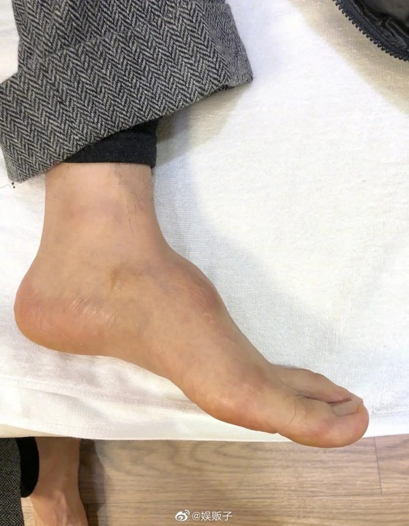 黄晓明自爆左脚植钢钉  全是劣质钢丝惹祸!